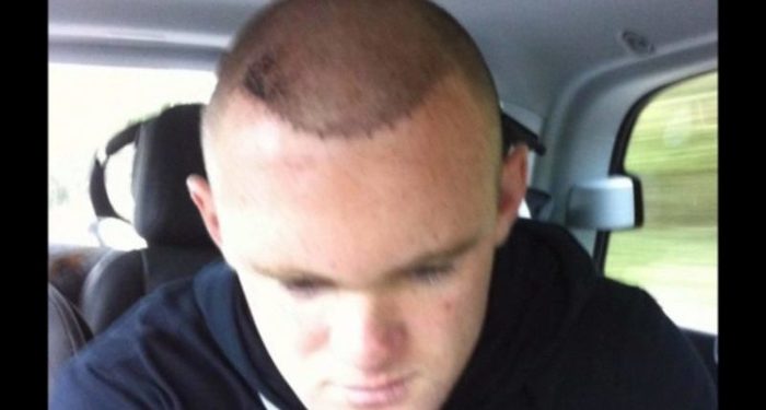 Rooney transplantes calvicie e1488472461729 Merca2.es