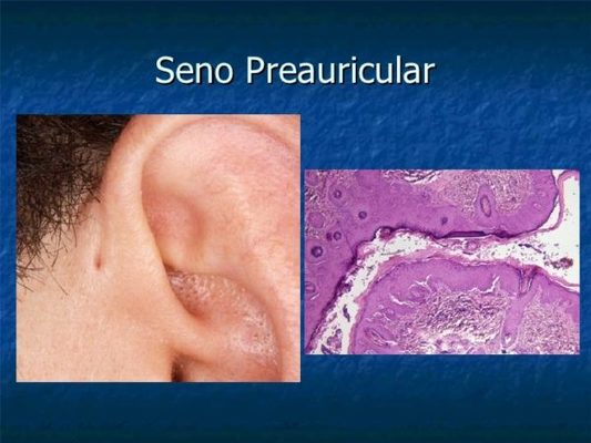 agujero preauricular