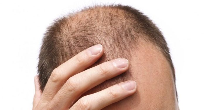 calvicie genetica no e1488472610911 Merca2.es