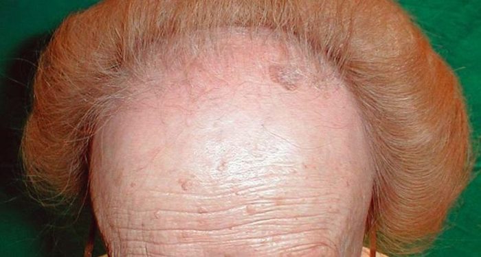 mujer calvicie e1488472262883 Merca2.es