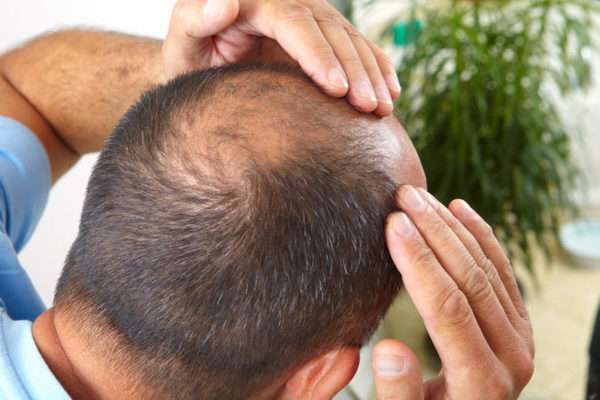Las células T reguladoras o Tregs, el crece-pelo más eficaz 53 Merca2.es Alopecia Merca2.es