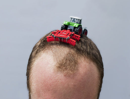 Las células T reguladoras o Tregs, el crece-pelo más eficaz 54 Merca2.es hair loss Merca2.es