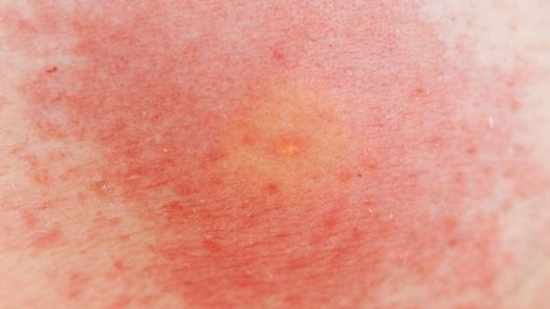 Picadura de avispa: qué hacer cuando te pican 4 Merca2.es picadura