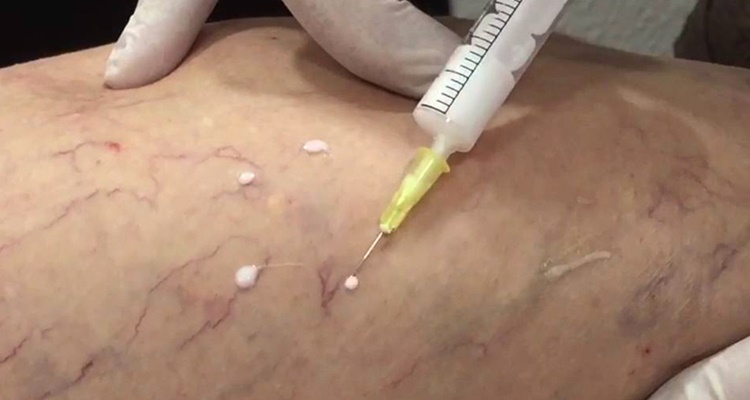 Esclesorado contra las varices