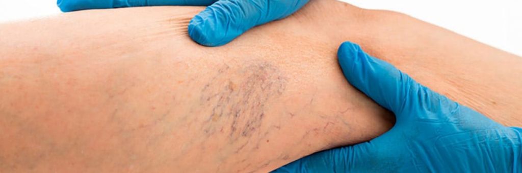 Laserfotona para eliminar varices