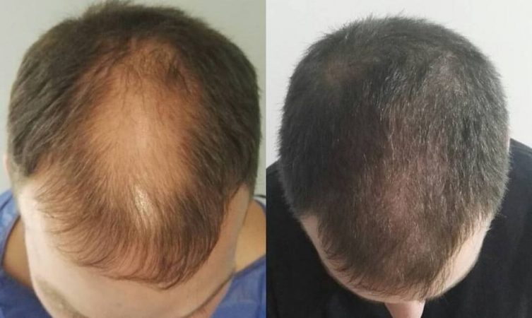 Precios de un implante capilar