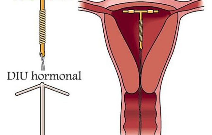 Cáncer de endometrio: estos son los factores que influyen el desarrollo de la enfermedad 3 Merca2.es Cáncer