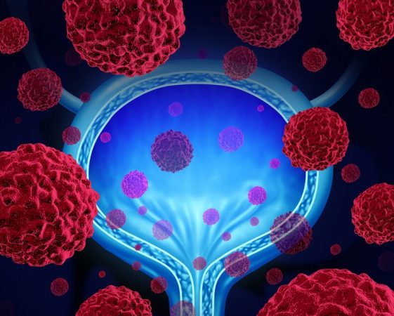 Cáncer de vejiga, las claves para detectarlo a tiempo 1 Merca2.es cáncer