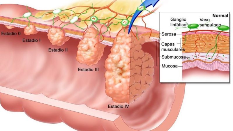 Cáncer de estómago: las causas que lo provocan 3 Merca2 cáncer metaplasia intestinal