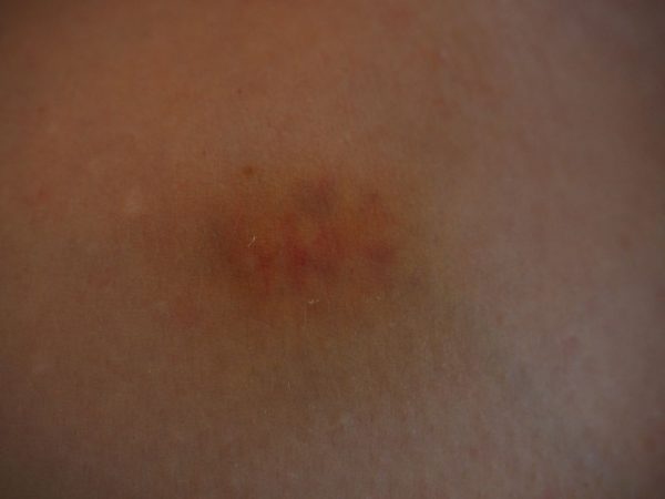 hematomas por diabetes