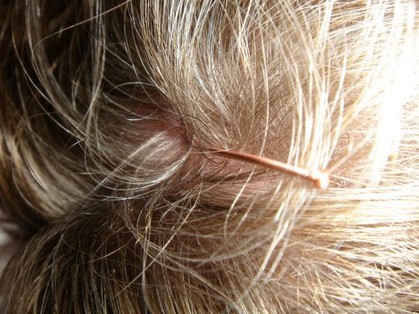 acupuntura de cabeza