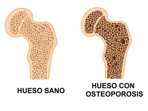 hueso con osteoporosis