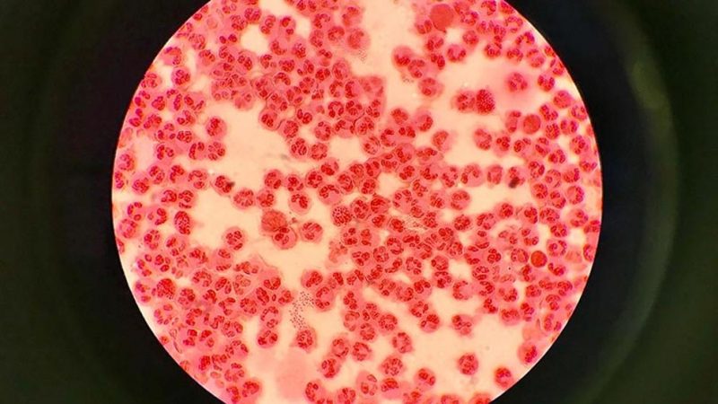 gonorrea al microscopio