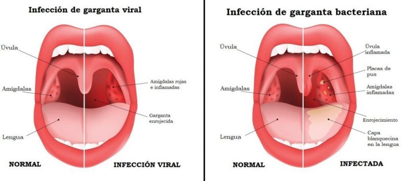 infección