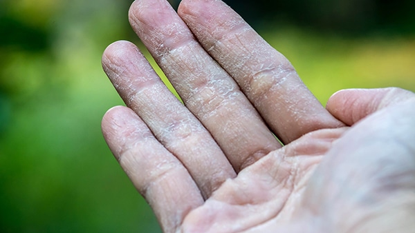 dermatitis