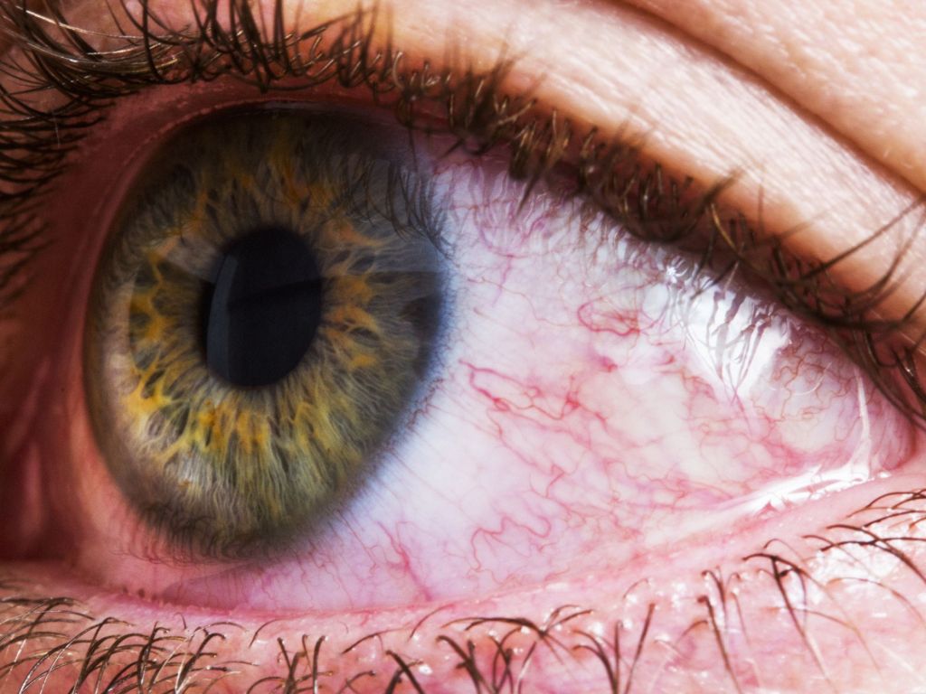 ojo enrojecido