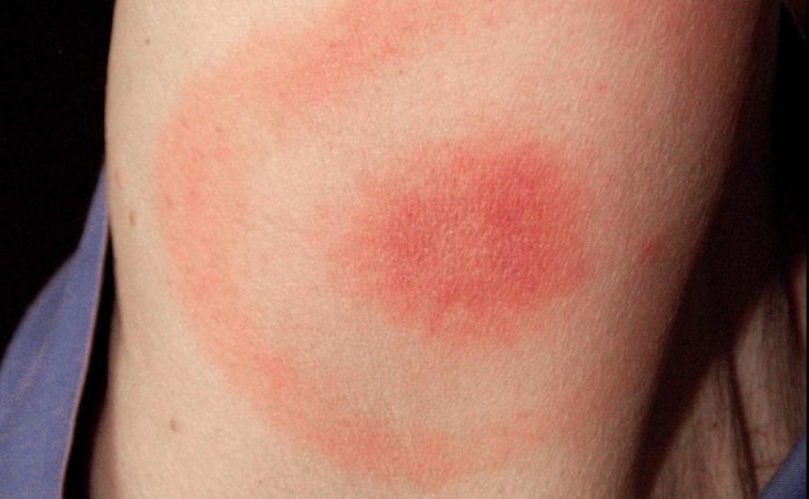 enfermeda lyme Merca2.es