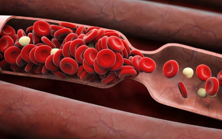 Coágulos de sangre y sus implicaciones
