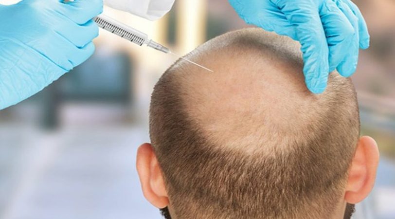 Plasma rico en plaquetas para la calvicie Merca2.es