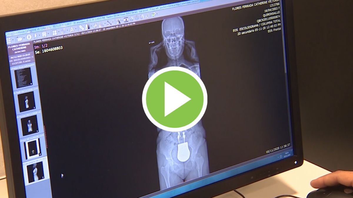 Operación pionera de escoliosis realizada en Barcelona