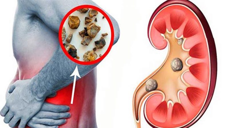 Protege al corazón y evita los riesgos de cálculos renales