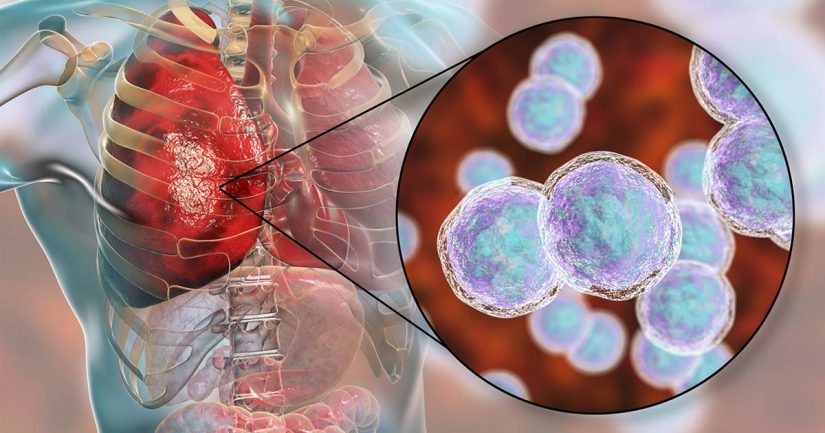 Neumonía: los síntomas más claros de que padeces esta enfermedad 66 Merca2.es ¿Cuáles son las causas de la neumonía?