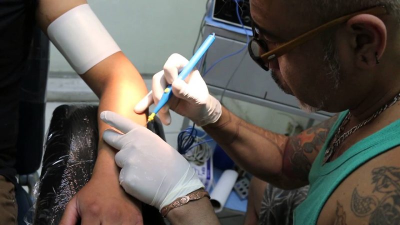 Esto es lo que tienes que hacer para quitarte un tatuaje 75 Merca2.es Mediante la técnica de remoción quirúrgica