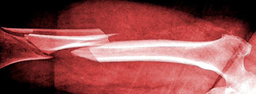 Posibles daños óseos