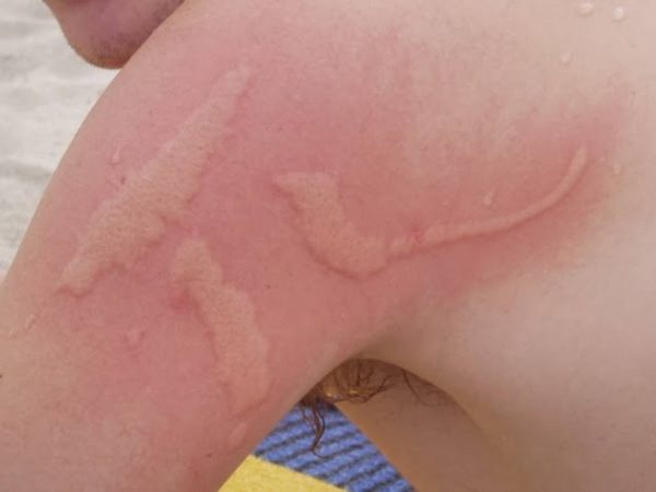 Cómo se debe actuar en los casos de picadura de medusa