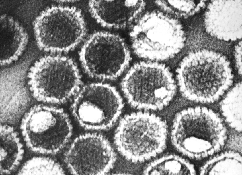 virus del herpes