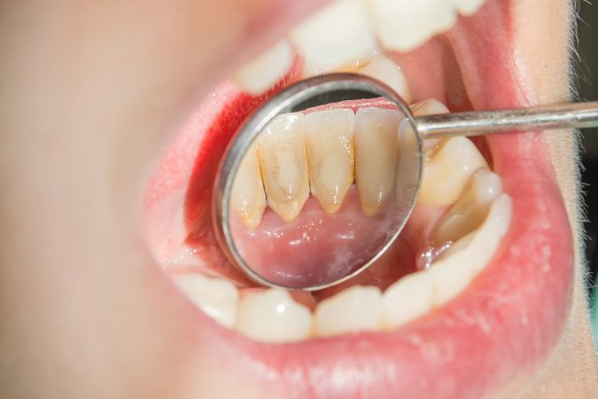 Cómo eliminar el sarro de los dientes sin tener que ir al dentista 72 Merca2.es 2 07092020120707 mejor remedio casero eliminar sarro Merca2.es