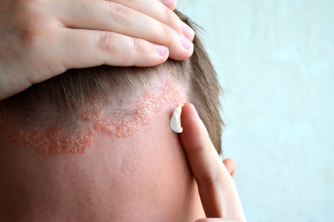 Estos son los problemas que el estrés puede ocasionar en tu piel 12 Merca2.es Dermatitis seborreica estrés