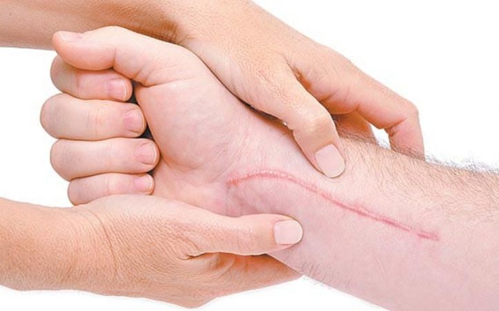 Estos son los problemas que el estrés puede ocasionar en tu piel 16 Merca2.es Mala cicatrización de heridas estrés