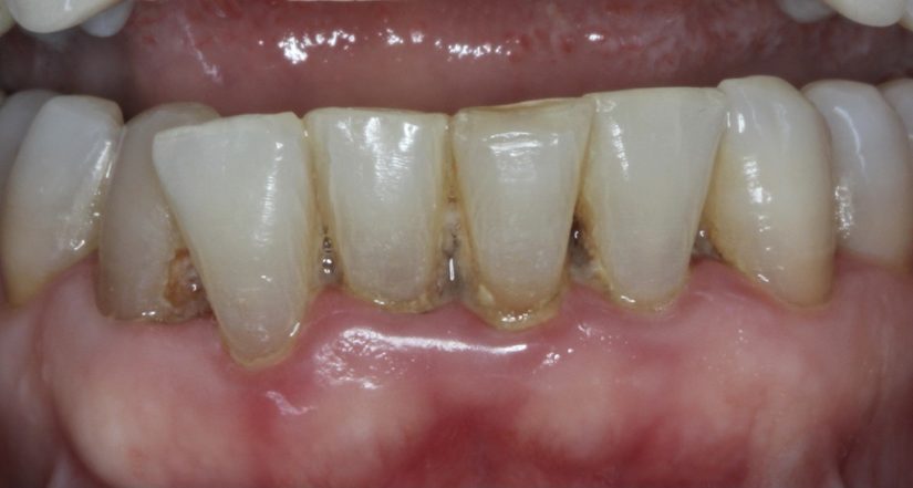 Cómo eliminar el sarro de los dientes sin tener que ir al dentista 67 Merca2.es MicrosoftTeams image 4 1 Merca2.es