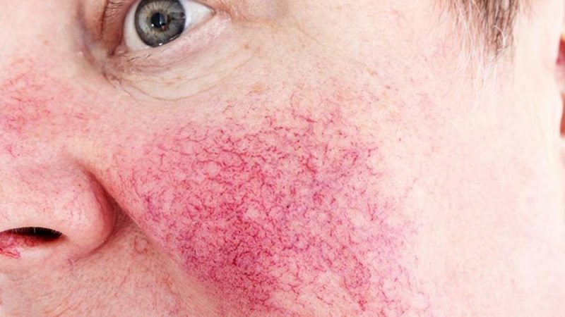 Estos son los problemas que el estrés puede ocasionar en tu piel 15 Merca2.es Rosácea estrés