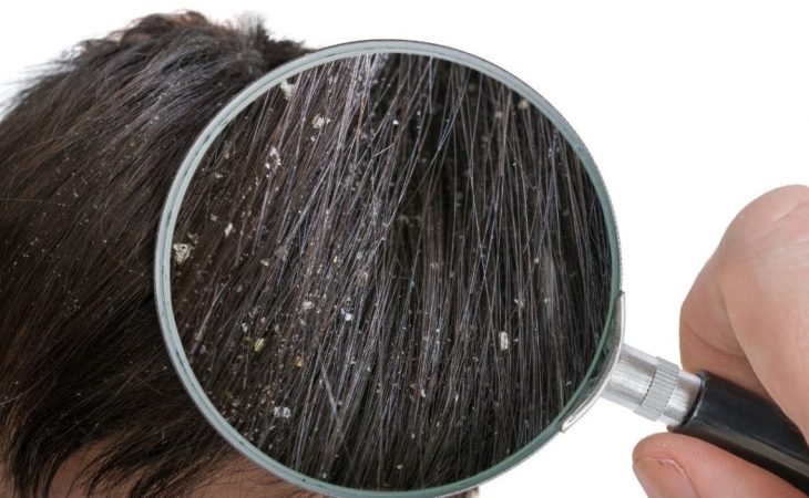 El asombroso motivo que no te creerás por el que tu pelo se puede llenar de caspa 37 Merca2.es El asombroso motivo que no te creerás por el que tu pelo se puede llenar de caspa