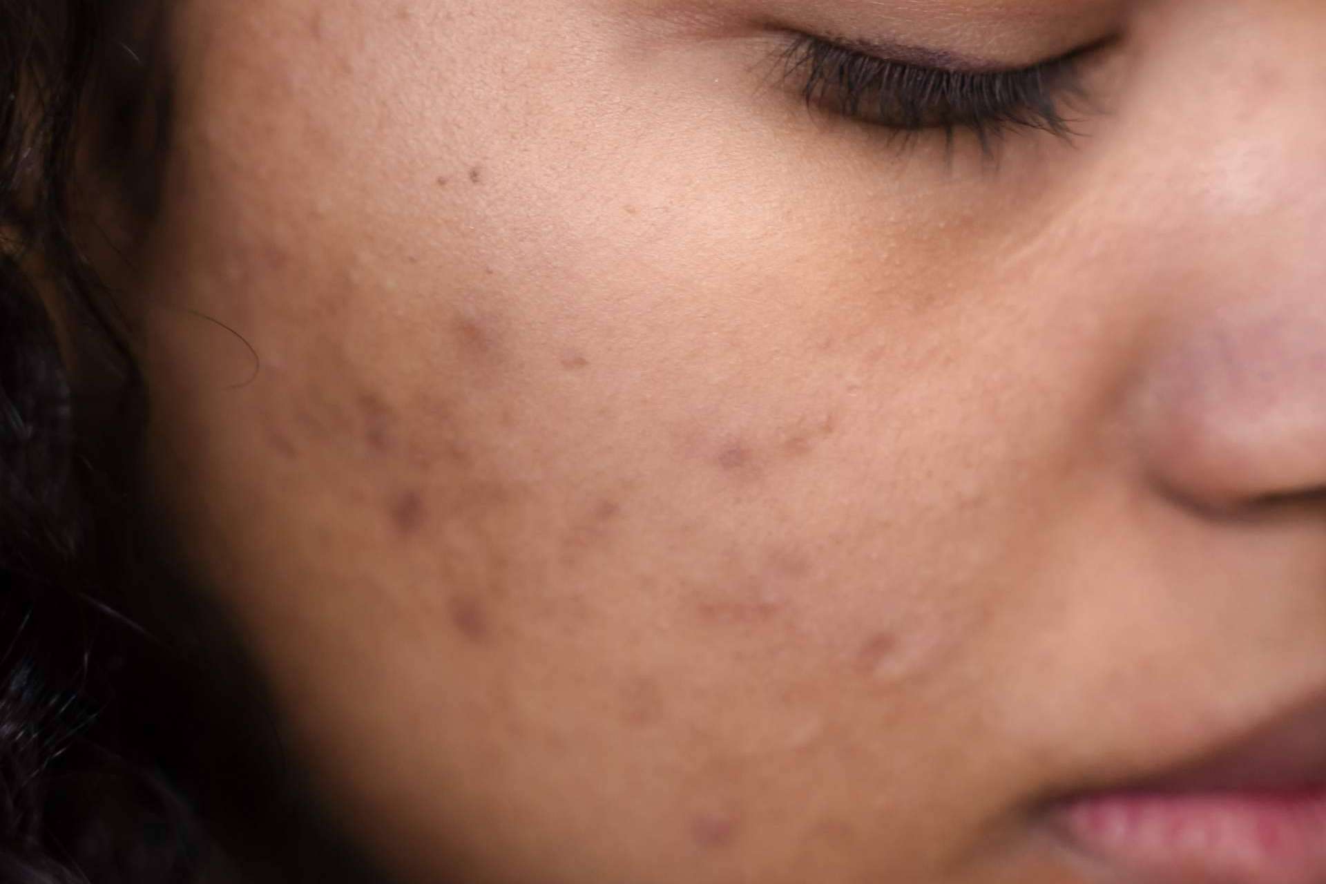 ¿Cuáles son los beneficios del tratamiento contra el acné de Bėyo Beauty?