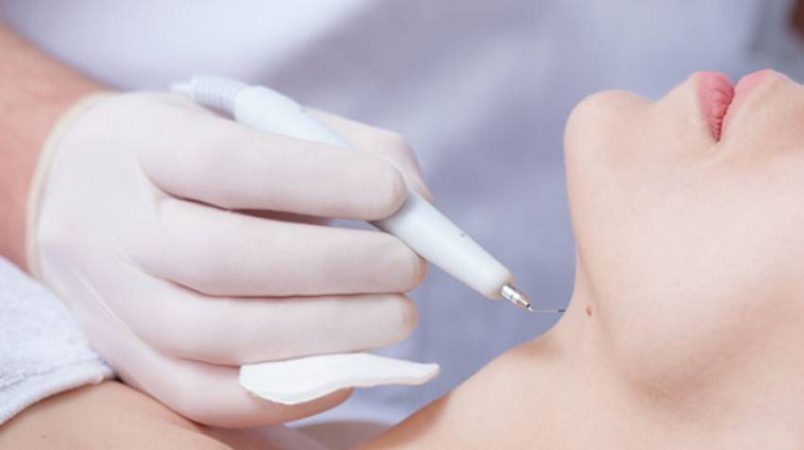 Como eliminan las verrugas del cuello los médicos