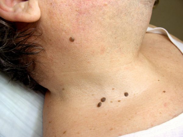 Como se forman las verrugas