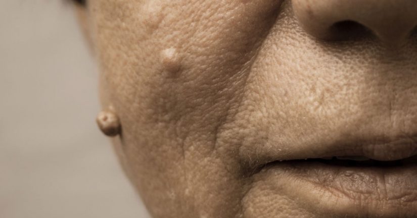 Que no debemos hacer cuando tengamos una verruga