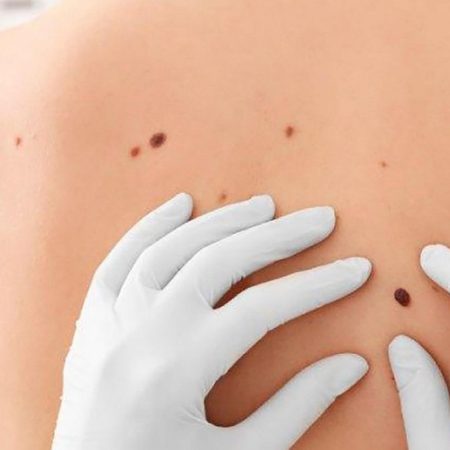 Relación entre las verrugas y cáncer de piel