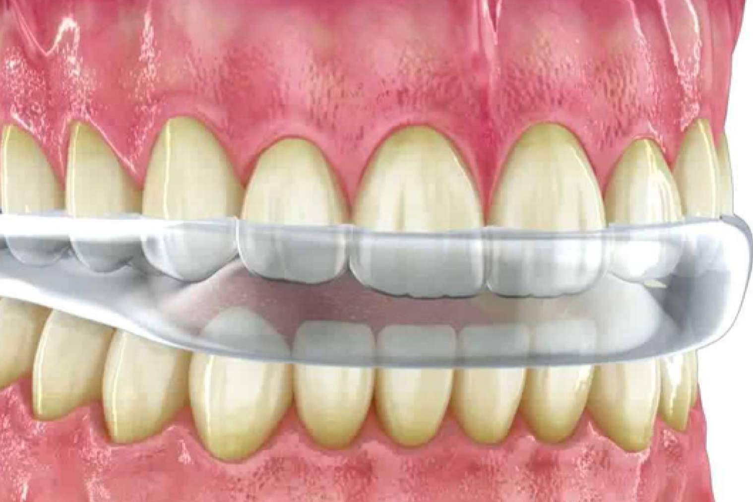 ¿Qué es el bruxismo y cómo se puede solucionar?, por Implant Clinics ¿Qué es el bruxismo y cómo se puede solucionar?, por Implant Clinics