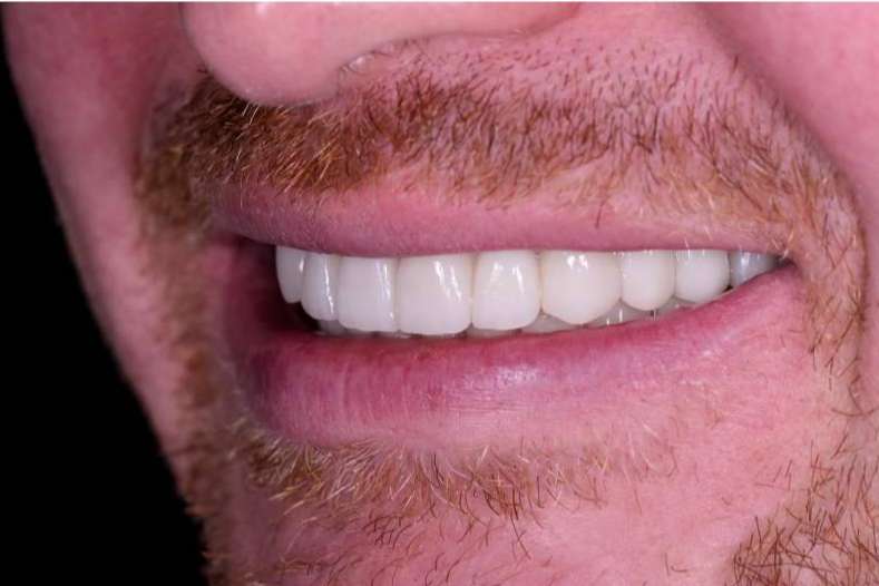 Colocar implantes en Valencia a pacientes con enfermedades periodontales es posible con los expertos de Clínica Viasalud