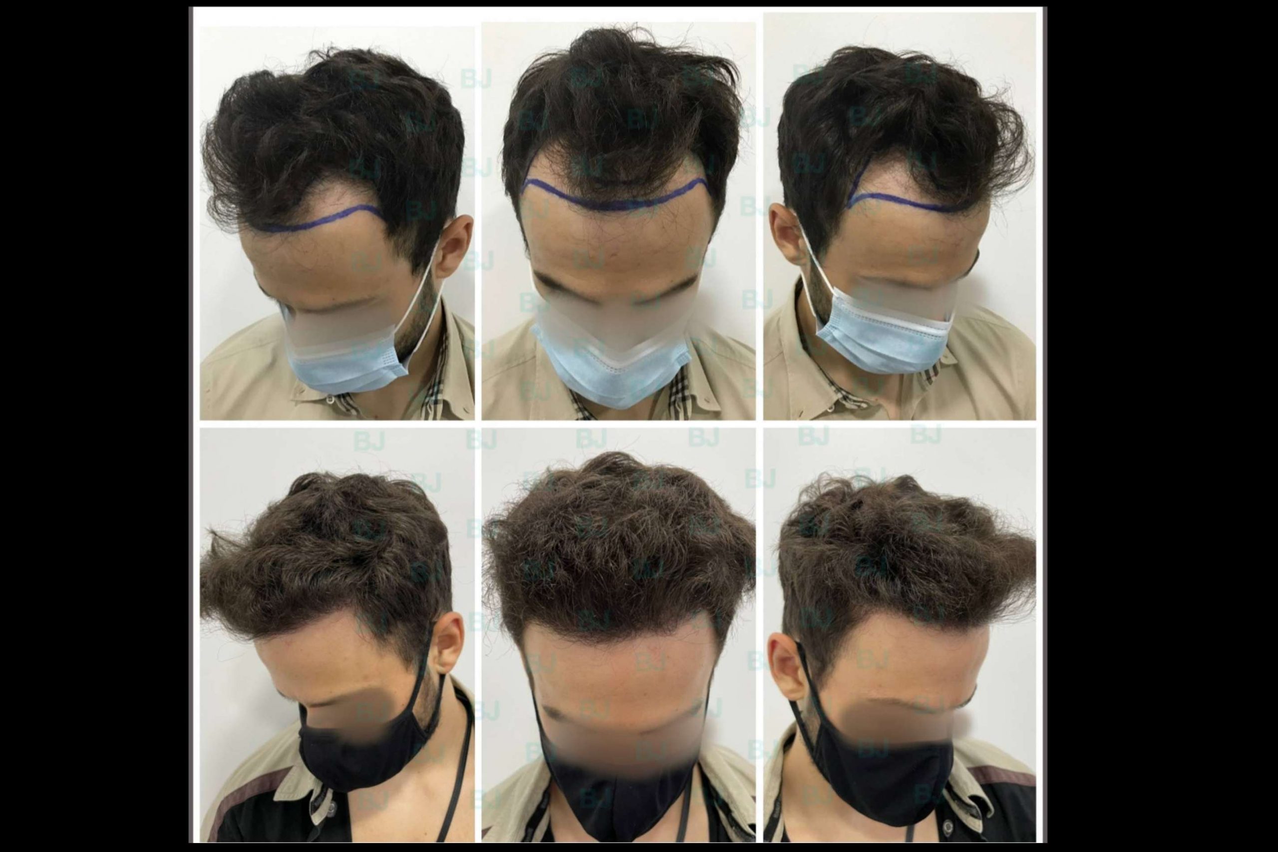 Dr. Jacobovski, experto en injerto capilar