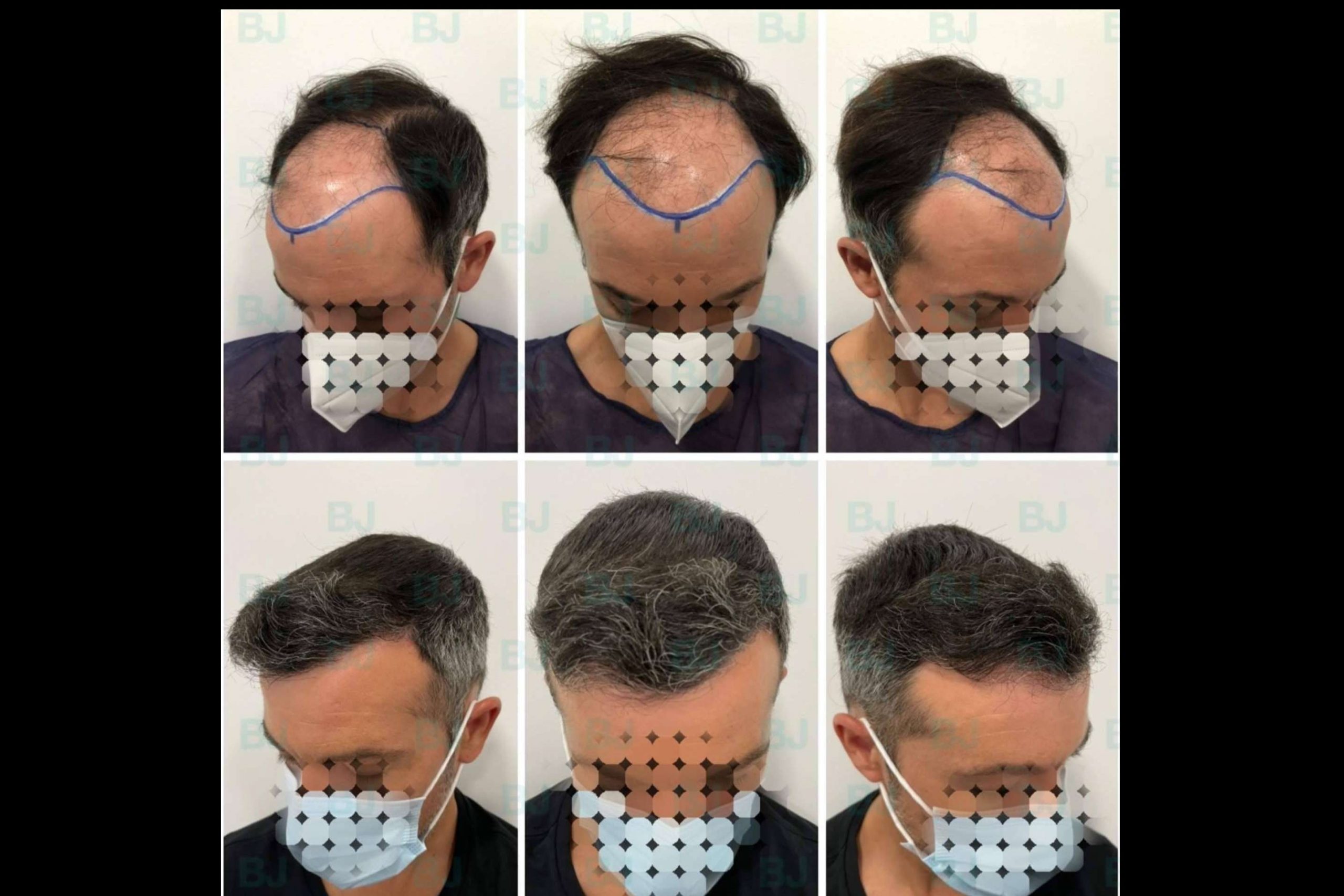 Todo lo que se debe saber sobre un posoperatorio injerto capilar