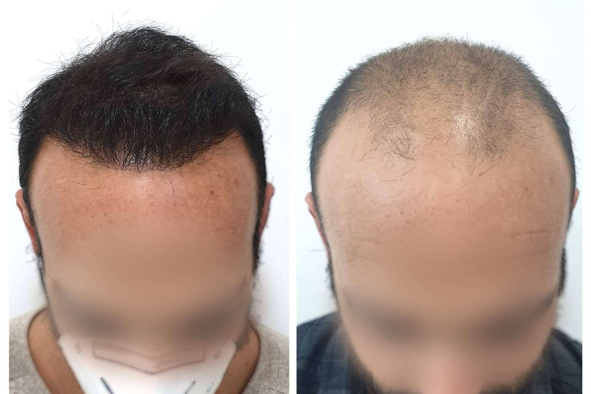 Injermur explica cómo se puede combatir la alopecia androgénica