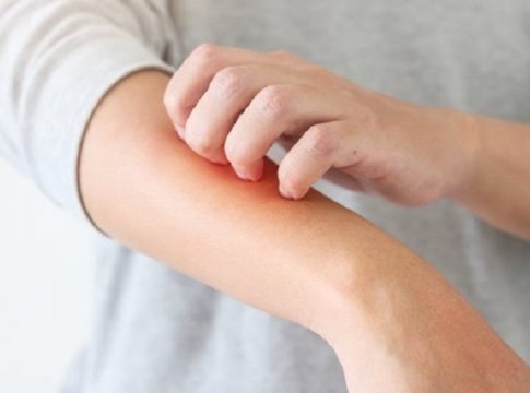 piel atópica dermatitis atópica