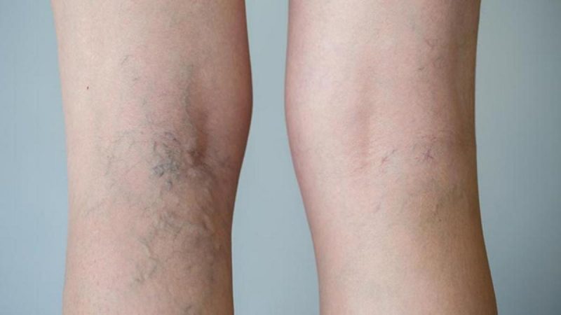 ¿Cómo se presentan las várices?