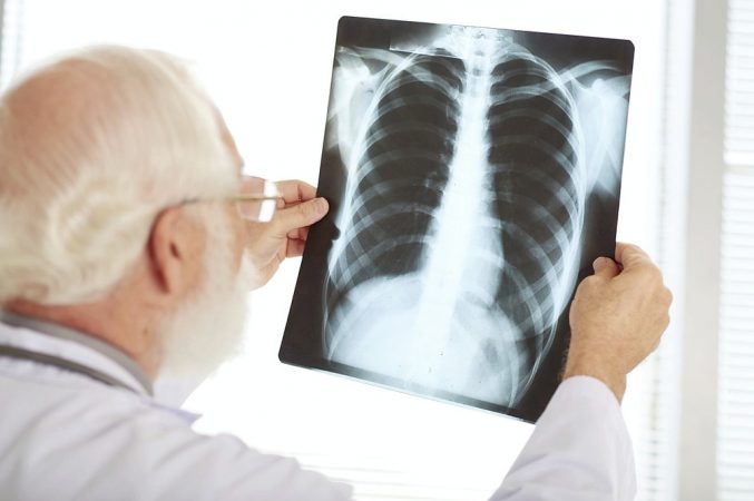 ¿Qué es el cáncer de pulmón según la AECC?