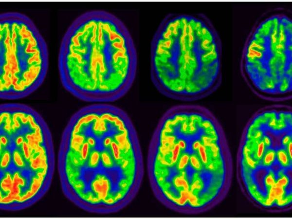 Alzheimer higiene dental